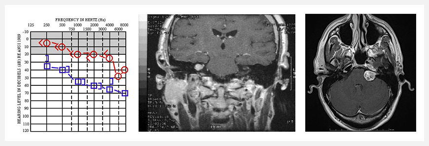 聽神經(jīng)瘤診斷