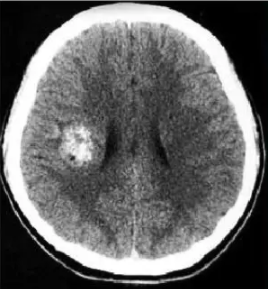 致命的腦干海綿狀血管瘤出血，立即手術(shù)還是保守治療?