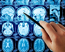 丘腦膠質(zhì)瘤能治愈嗎?