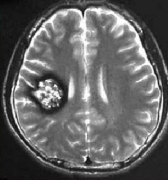 顱內(nèi)海綿狀血管瘤長在“手術禁區(qū)”，到底如何治療?
