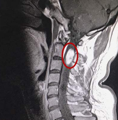 解密脊髓腫瘤：要盡早手術(shù)更要選對技術(shù)