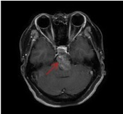 脊索瘤好治嗎?預(yù)計(jì)壽命和切除率是多少?