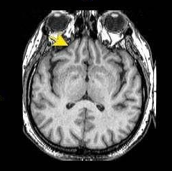 小兒松果體區(qū)腫瘤怎么治?國際多種前沿治療方式可合適治療