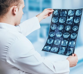 【膠質瘤病因】人為什么會得膠質瘤？