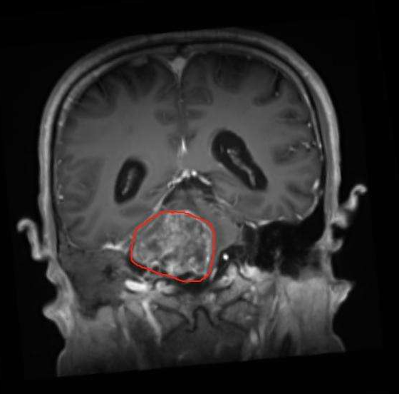 膠質(zhì)瘤能活多久?提高膠質(zhì)瘤存活率的合適治療途徑