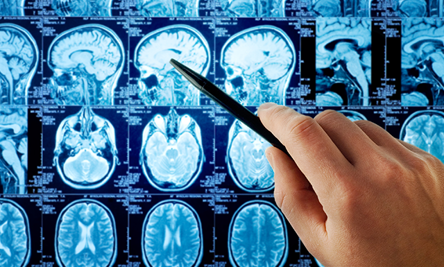 腦膜瘤3Cm嚴(yán)重嗎?腦膜瘤手術(shù)后多久恢復(fù)？