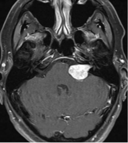 聽力下降警惕腦瘤：數(shù)次不重視，聽神經(jīng)瘤在她腦中生長了十年