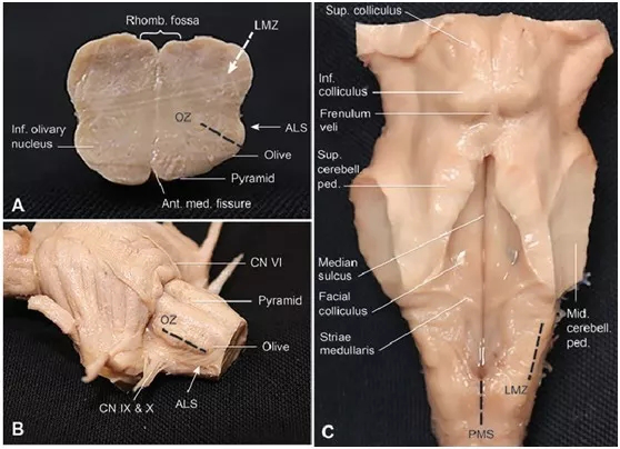 腦干延髓腫瘤順利全切可能嗎？?jī)蓜t成功案例交流