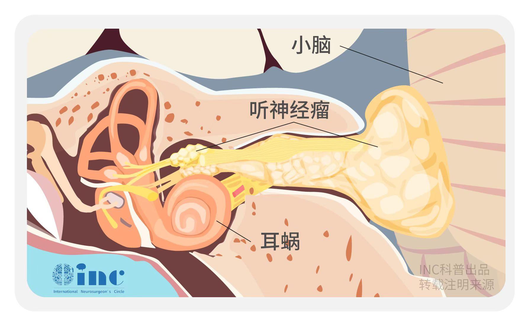 聽神經(jīng)瘤進(jìn)展會(huì)出現(xiàn)哪9大癥狀？治療后都能恢復(fù)嗎？手術(shù)關(guān)鍵是什么？