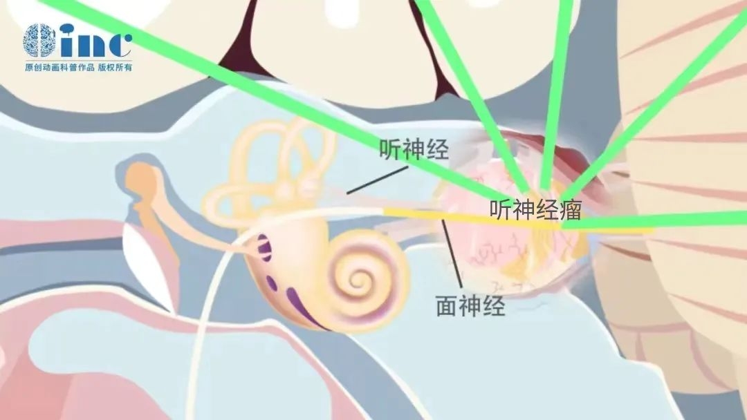 聽神經(jīng)瘤面癱的九大必知問題【術中篇】