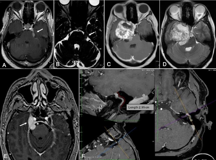 面神經(jīng)鞘瘤術(shù)后多久能恢復(fù)