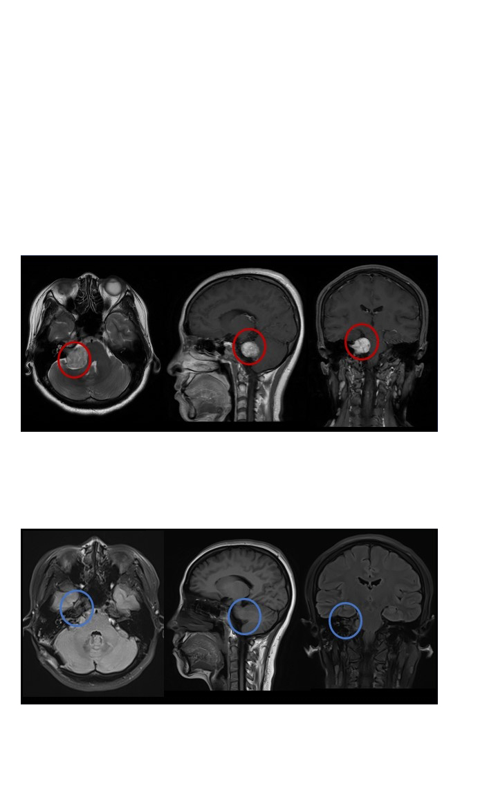 聽神經(jīng)瘤開顱手術(shù)后多久能恢復(fù)正常