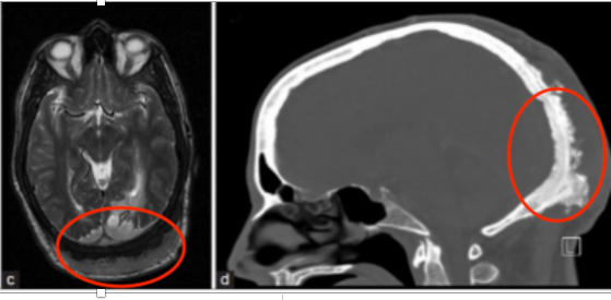 腦膜瘤手術(shù)風(fēng)險大嗎?-1