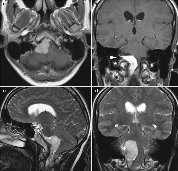 枕大孔區(qū)<a href='/bingzhong/naomoliu/' target='_blank'><u>腦膜瘤</u></a>手術(shù)難度大嗎