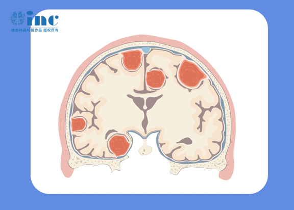 腦膜瘤的較佳治療方法