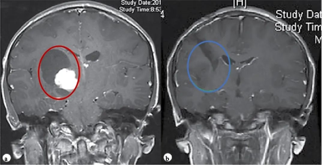 毛細(xì)胞型星形細(xì)胞瘤1級會復(fù)發(fā)嗎-3