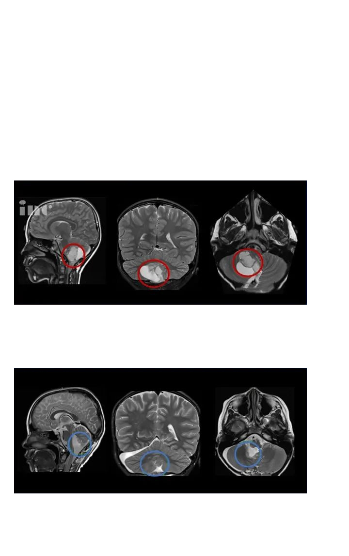 毛細(xì)胞型星形細(xì)胞瘤病理-5