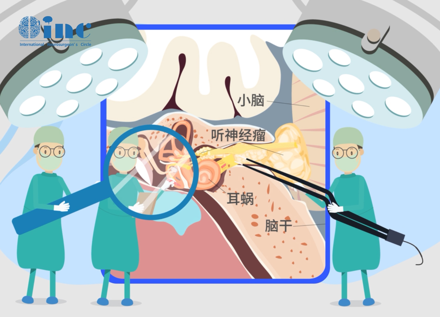 聽(tīng)神經(jīng)瘤手術(shù)中如何保護(hù)面神經(jīng)？術(shù)中面神經(jīng)功能的電生理監(jiān)測(cè)與評(píng)估怎么做？