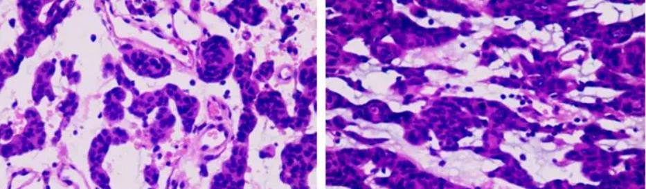 脊索樣腦膜瘤真的活不長？脊索樣腦膜瘤的遺傳學(xué)和基因組分析