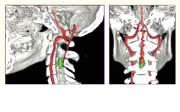 血管母細胞瘤手術(shù)風險大嗎1