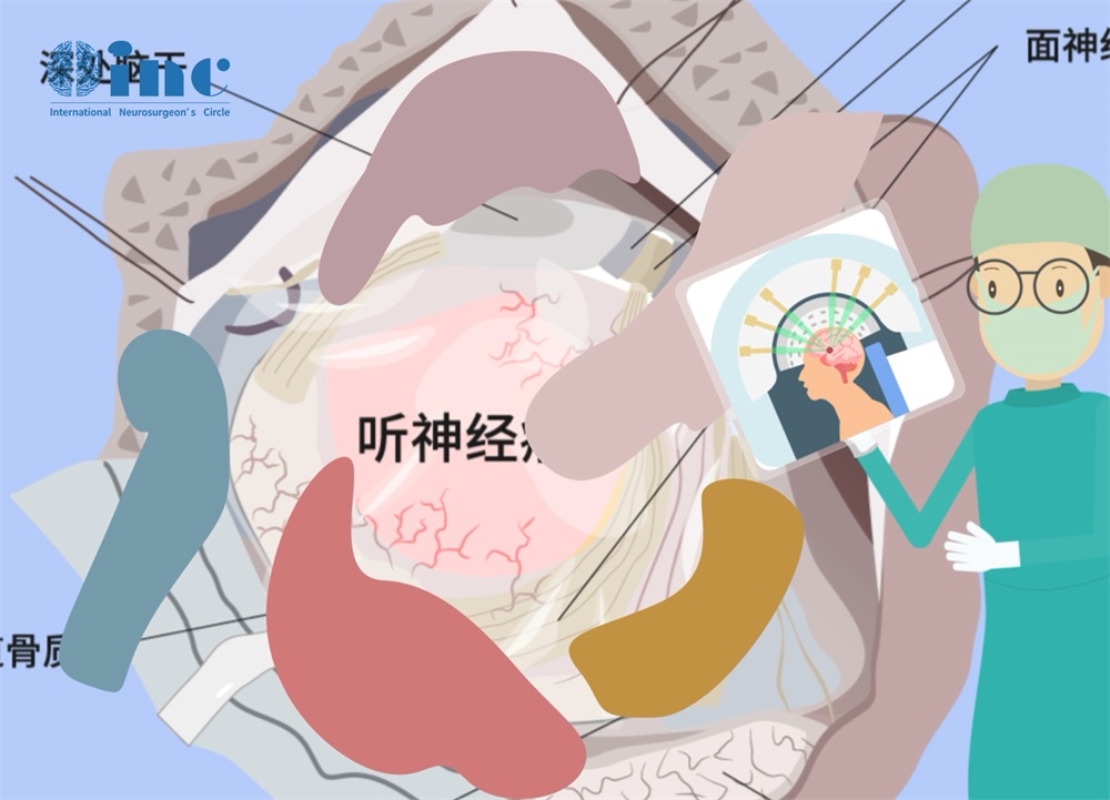 聽(tīng)神經(jīng)瘤手術(shù)風(fēng)險(xiǎn)大嗎2