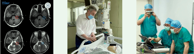 INC成功手術(shù)案例之CPA橋小腦角區(qū)腦膜瘤能既全切，又保聽(tīng)力、不面癱嗎？