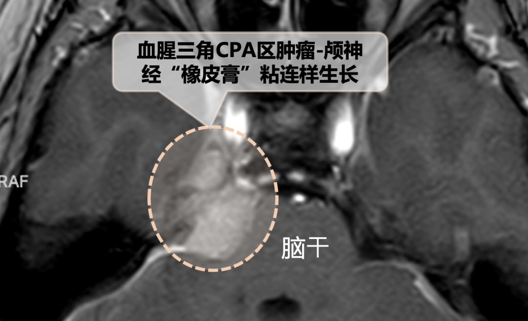 天壇醫(yī)院手術(shù)隨訪 | “無癥狀”腦瘤要不要切？一場手術(shù)讓她重獲“說走就走”的西藏之旅