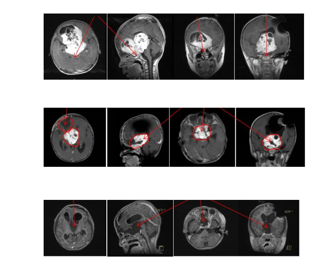 視神經(jīng)膠質(zhì)瘤有治愈的案例嗎