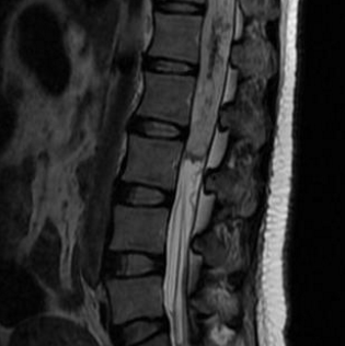 脊髓腫瘤是良性還是惡性？