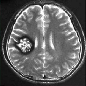 腦海綿狀血管瘤