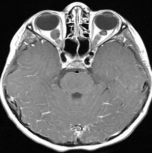 視神經(jīng)膠質(zhì)瘤