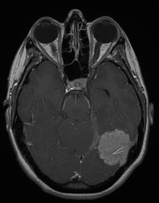 良性腦膜瘤能活多久？腦膜瘤不做手術可以嗎？