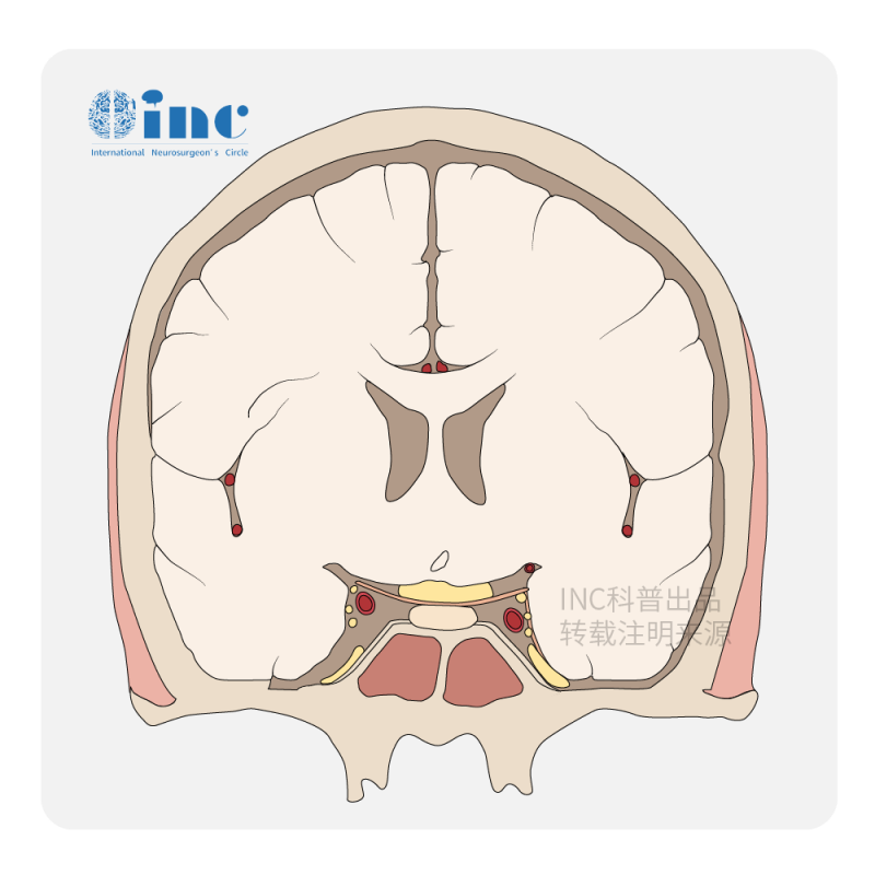 腦膜瘤是怎么引起的？腦膜瘤早期癥狀有哪些？
