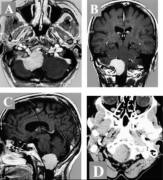 腦膜瘤治療指南，腦膜瘤治療方法有幾種?