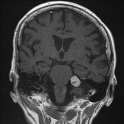 聽神經(jīng)瘤是怎么形成的？有哪些癥狀