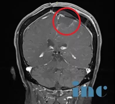 顱內(nèi)較大腦膜瘤案例術(shù)前