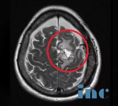 顱內(nèi)較大腦膜瘤案例術(shù)后