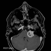 聽(tīng)神經(jīng)瘤是大手術(shù)嗎？聽(tīng)神經(jīng)瘤手術(shù)后恢復(fù)期詳述