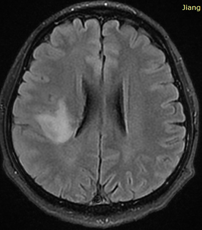 膠質(zhì)瘤治療
