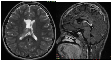膠質(zhì)瘤治療