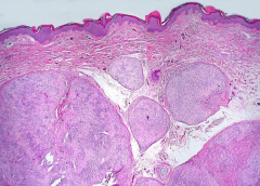 聽神經(jīng)瘤的主要臨床表現(xiàn)有哪些？聽神經(jīng)瘤怎么治療好？