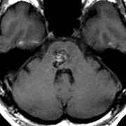 問：如果沒有癥狀，腦海綿狀血管瘤不用治療嗎？