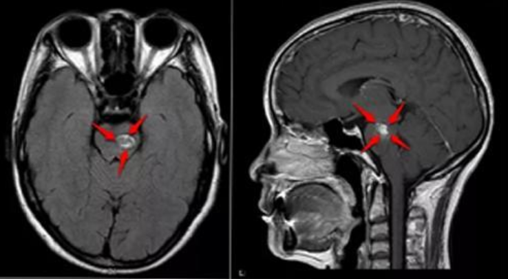腦干海綿狀血管瘤手術(shù)治療