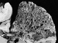 兒童腦動(dòng)靜脈畸形手術(shù)成功率