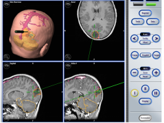 膠質(zhì)母細(xì)胞瘤能治好嗎？惡性腦腫瘤的納米外科切除