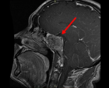 治療腦脊索瘤有哪些比較好的方法?