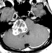 問(wèn)：聽(tīng)神經(jīng)瘤的主要臨床表現(xiàn)有哪些？聽(tīng)神經(jīng)瘤術(shù)后有后遺癥嗎？