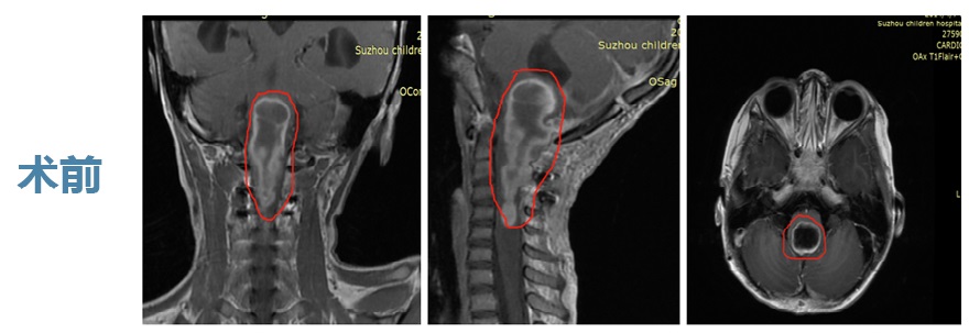 寶寶膠質(zhì)瘤能治愈嗎