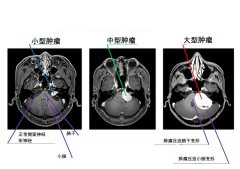 聽神經(jīng)瘤是大手術嗎？早期手術可降低聽力損失及面癱
