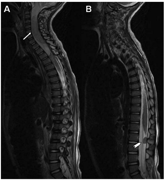 膠質(zhì)瘤-腦膠質(zhì)瘤